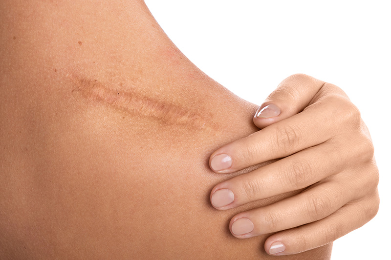 is-laser-treatment-effective-for-scars-new-leaf-new-u